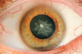 Science Weird: Man Punched in the Eye Gains Star Shaped Cataract 